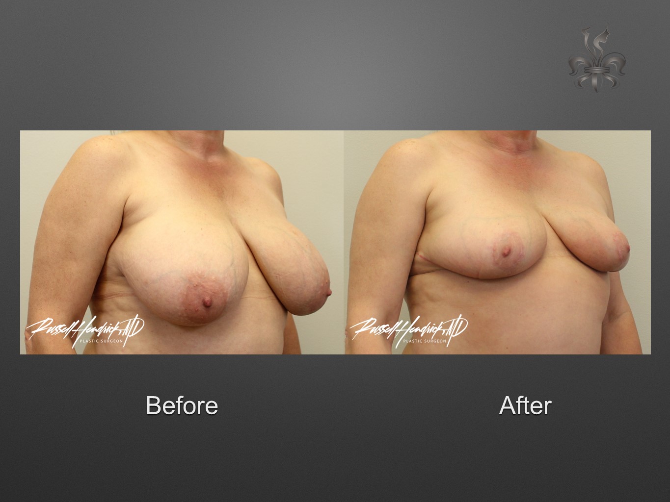 breast reduction before and after