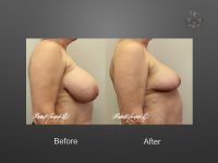 breast reduction before and after