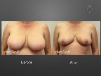 breast reduction before and after