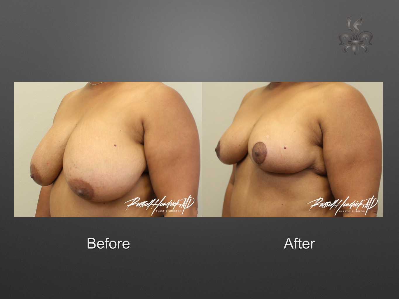 breast reduction before and after