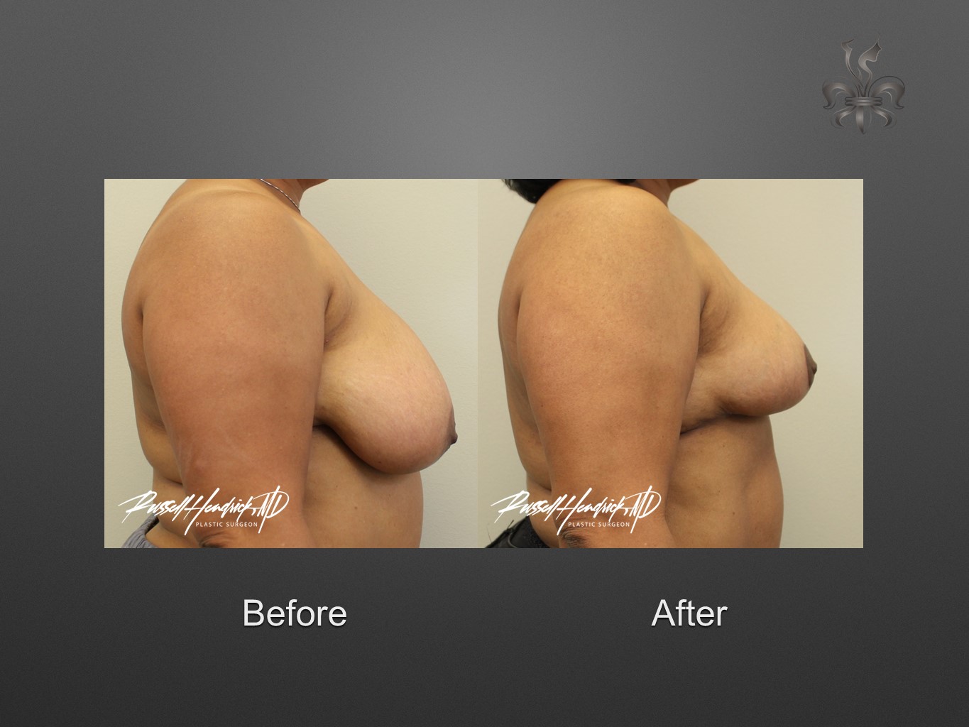 breast reduction before and after