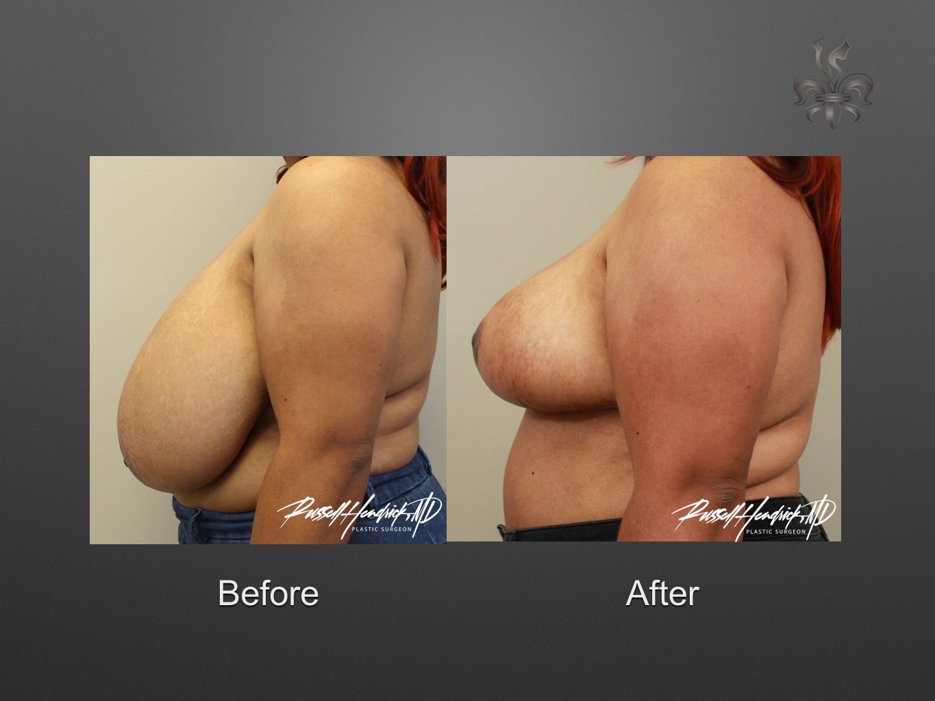 Gallery of Breast Reduction