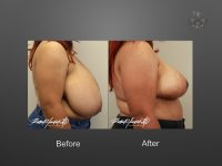 breast reduction before and after