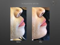 chin augmentation before and after