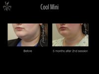 coolsculpting before and after