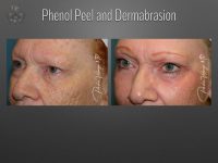 dermabrasion before and after