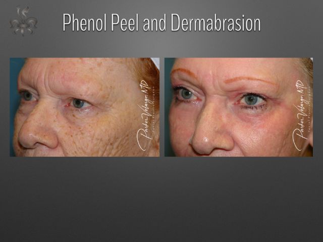 dermabrasion before and after