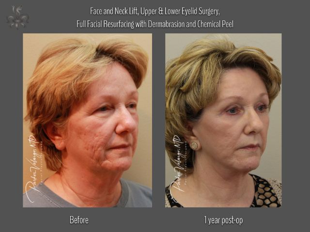 dermabrasion before and after