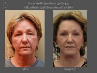 dermabrasion before and after