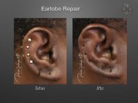 earlobe repair before and after