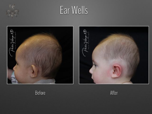 earwells before and after