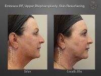 EmbraceRF before and after