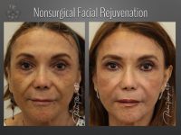 facelift before and after