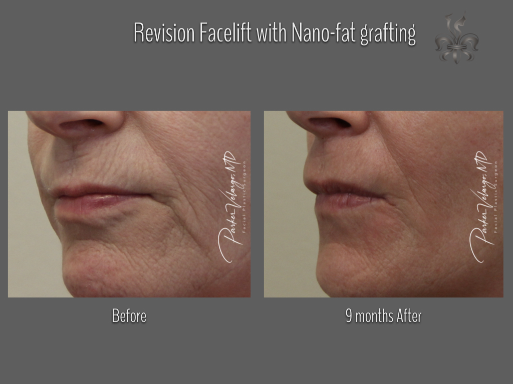 fat grafting before & after