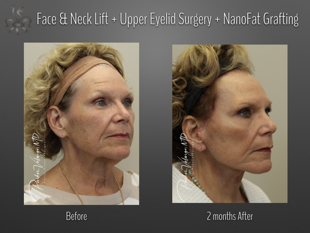 fat grafting before & after