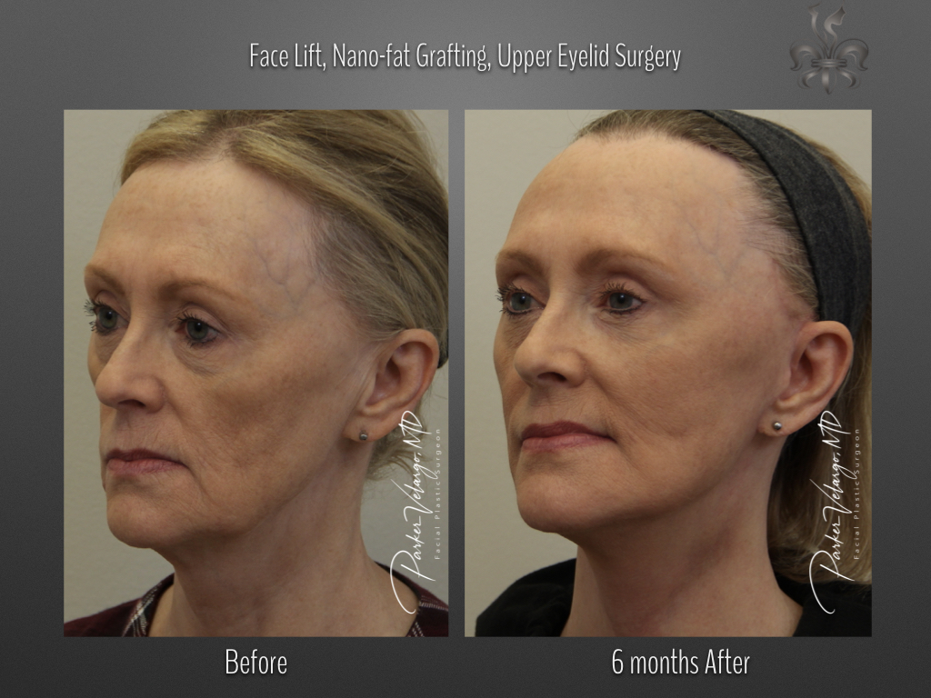 fat grafting before & after