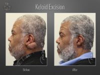 keloid excision before and after