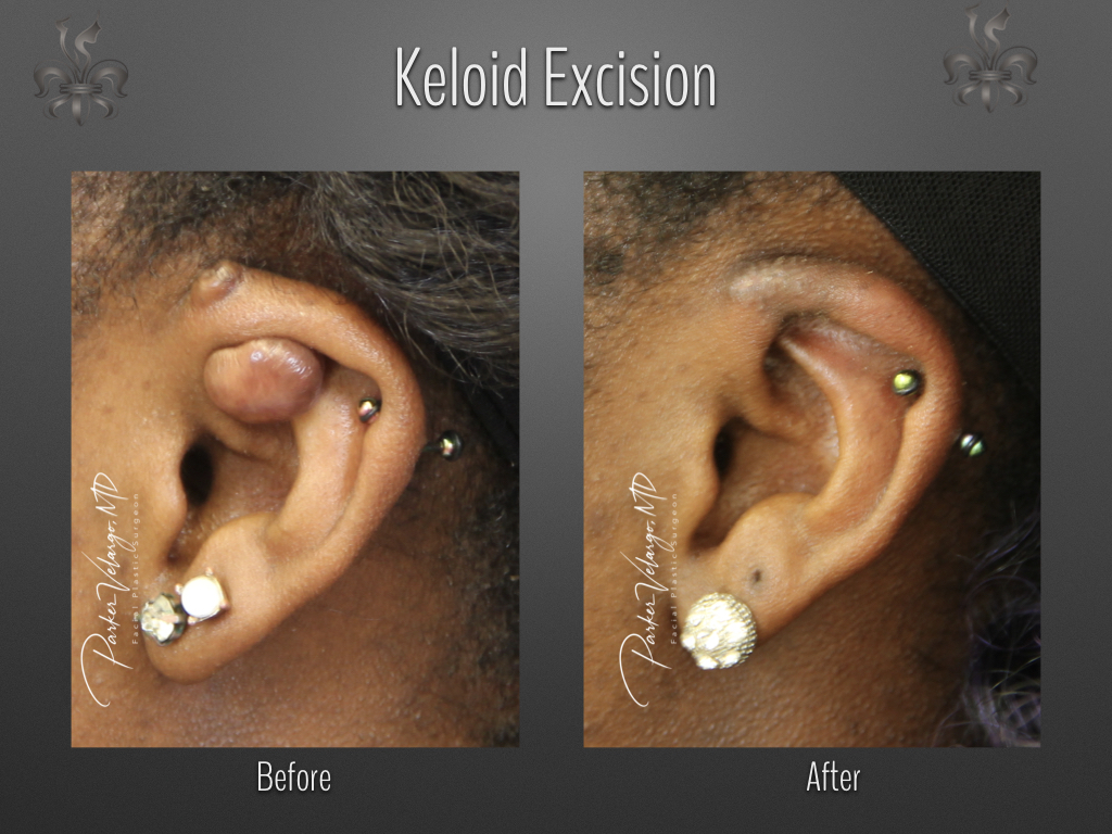 cpt code for excision of left earlobe keloid