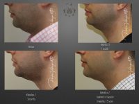 Kybella before and after