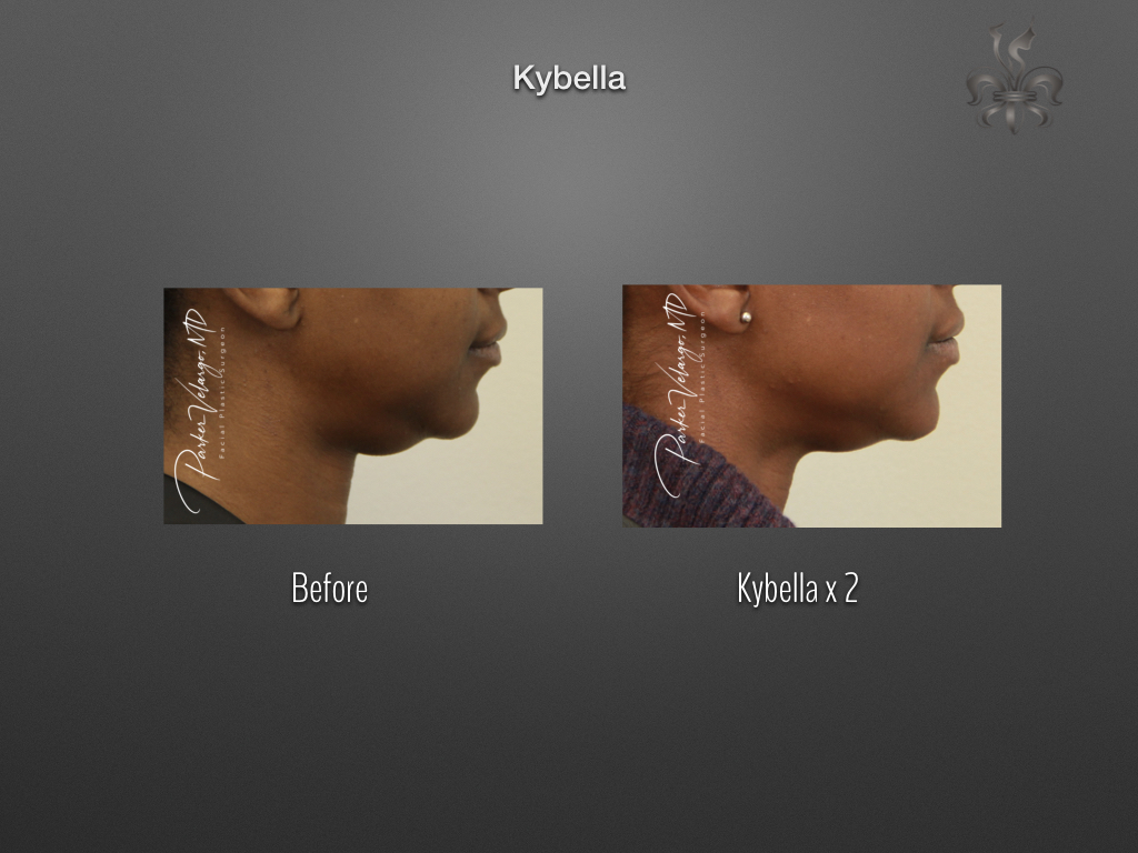 Kybella before and after