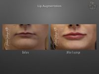 lip augmentation before and after