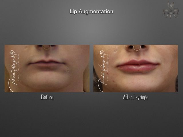 lip augmentation before and after