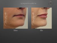 lip augmentation before and after