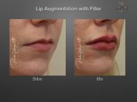 lip augmentation before and after