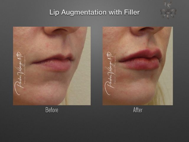lip augmentation before and after