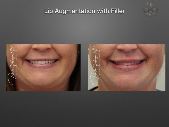 lip augmentation before and after
