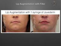 lip augmentation before and after