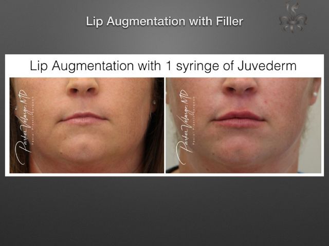lip augmentation before and after