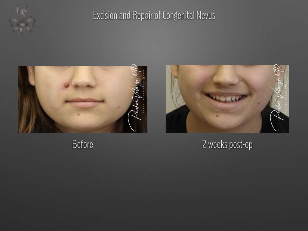nevus excision before & after