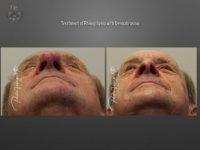 rhinophyma before and after