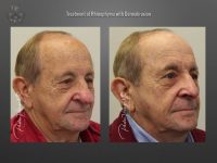 rhinophyma before and after