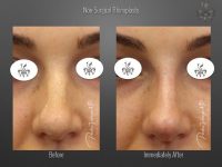rhinoplasty before and after