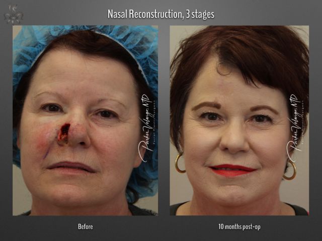 skin cancer reconstruction before and after