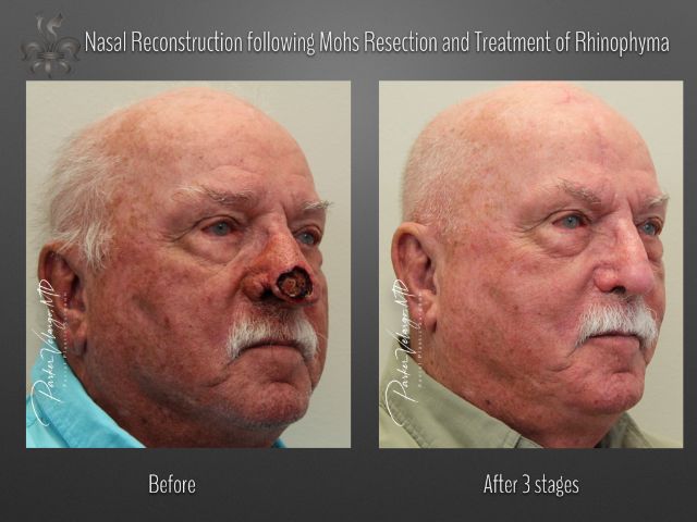 skin cancer reconstruction before and after