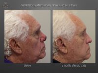 skin cancer reconstruction before and after