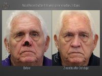 skin cancer reconstruction before and after