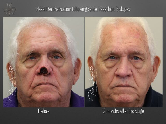 skin cancer reconstruction before and after