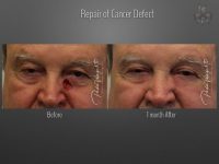 skin cancer reconstruction before and after