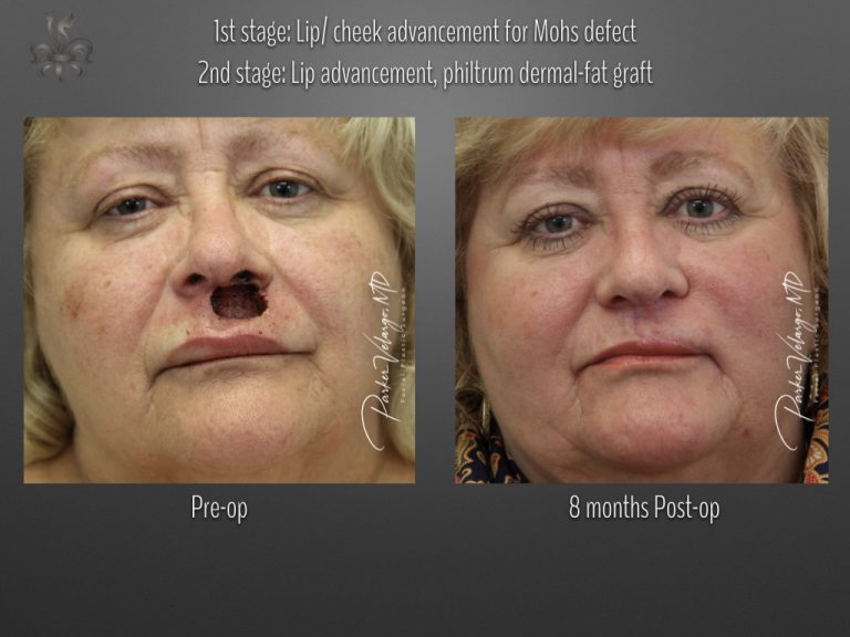 skin cancer reconstruction before & after