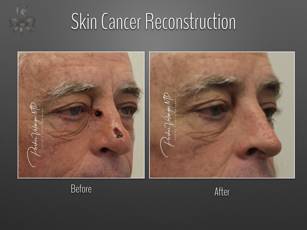 skin cancer reconstruction before & after