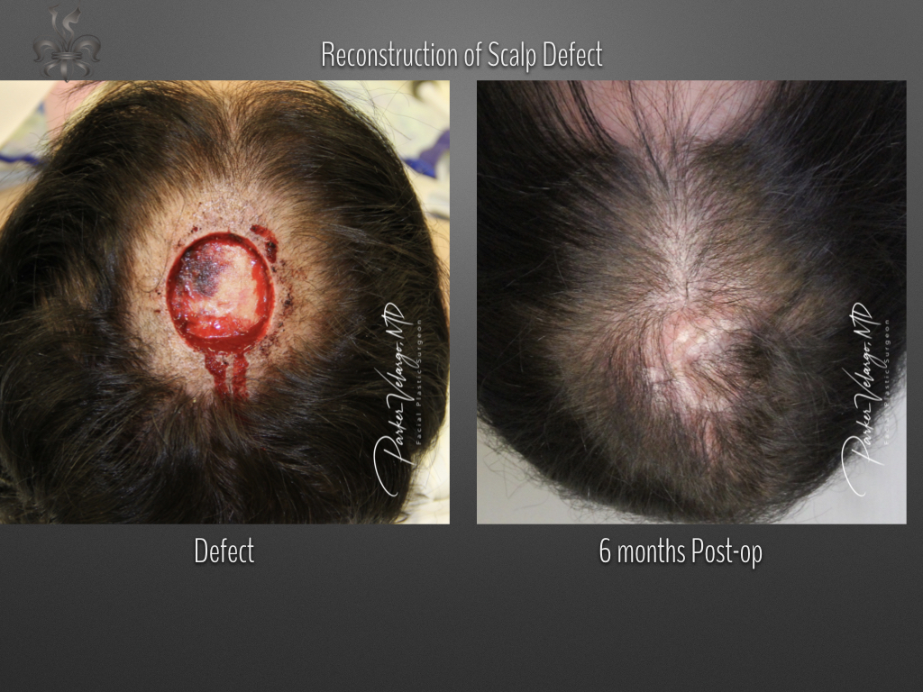 skin cancer reconstruction before & after