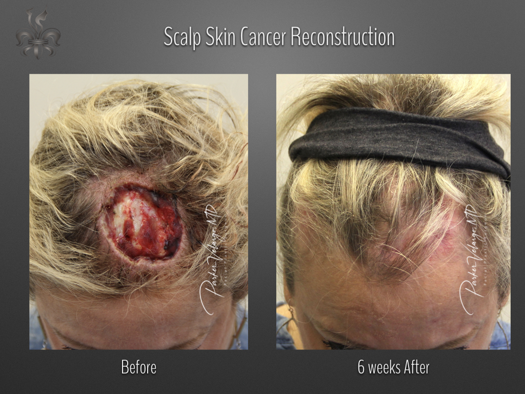 skin cancer reconstruction before & after