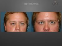 trauma repair before and after