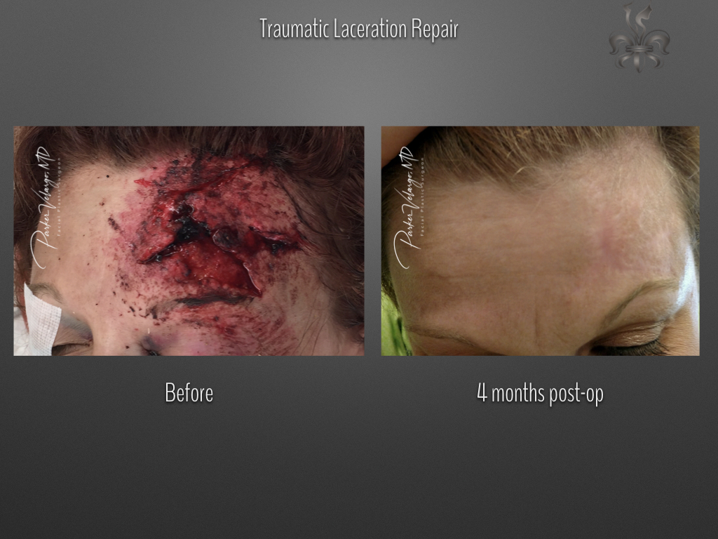trauma repair before & after