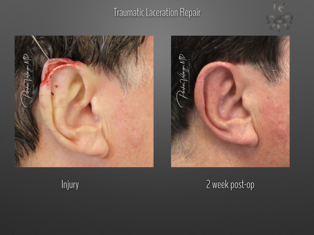 trauma repair before & after
