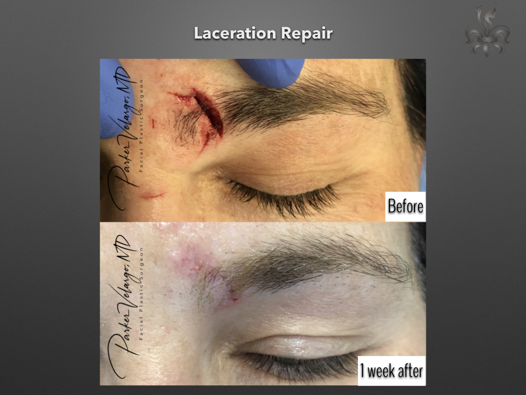 trauma repair before & after